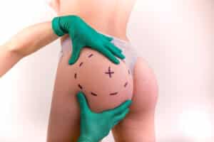 Surgeon marking correction lines on a woman’s body and buttocks before a plastic surgery procedure, illustrating preparation for a butt lift.
