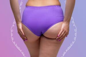 An overweight woman’s lower body is marked with surgical lines on a purple background, illustrating plans for buttocks liposuction, cellulite removal, and butt augmentation